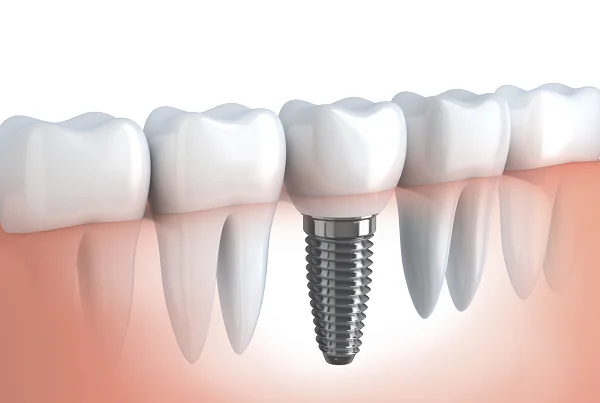 Dental Implant
