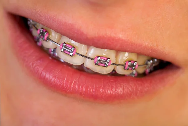 Teeth Alignment Braces
